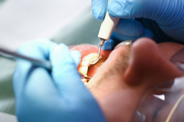 Best Emergency Dentist for Knocked-Out Tooth in Hinton, WV