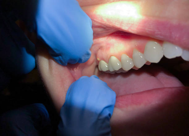 Best Emergency Dental Services for Seniors in Hinton, WV